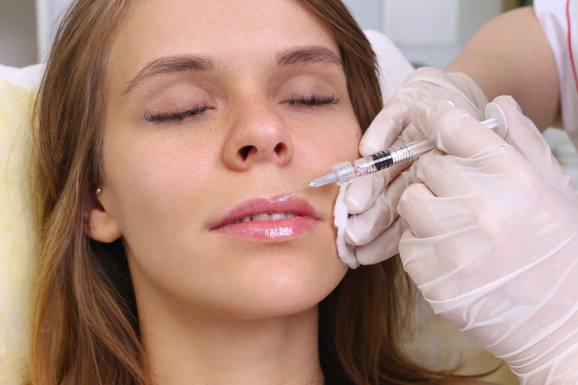 Lip Fillers