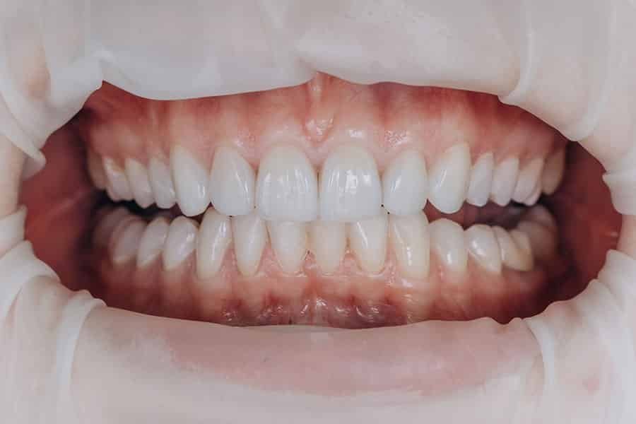 Dental Crown Specialist